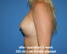 plastic-surgery-breast-augmentation